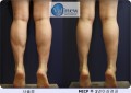 MICP  1̻  ׸ ȿ 